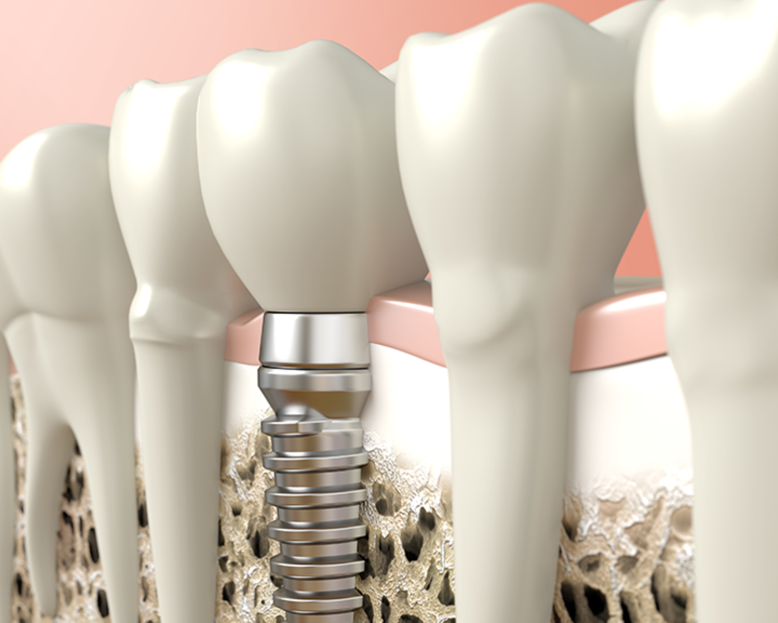 https://westbrookdentalcentre.com/wp-content/uploads/2017/10/Implant_Blog-2500x2000.png