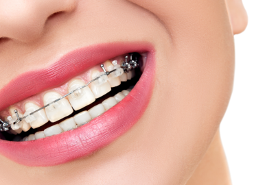 Orthodontic Post Procedure