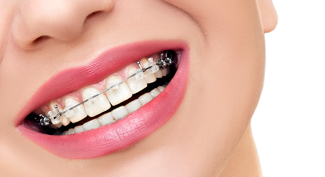 Cuidar los resultados de la ortodoncia